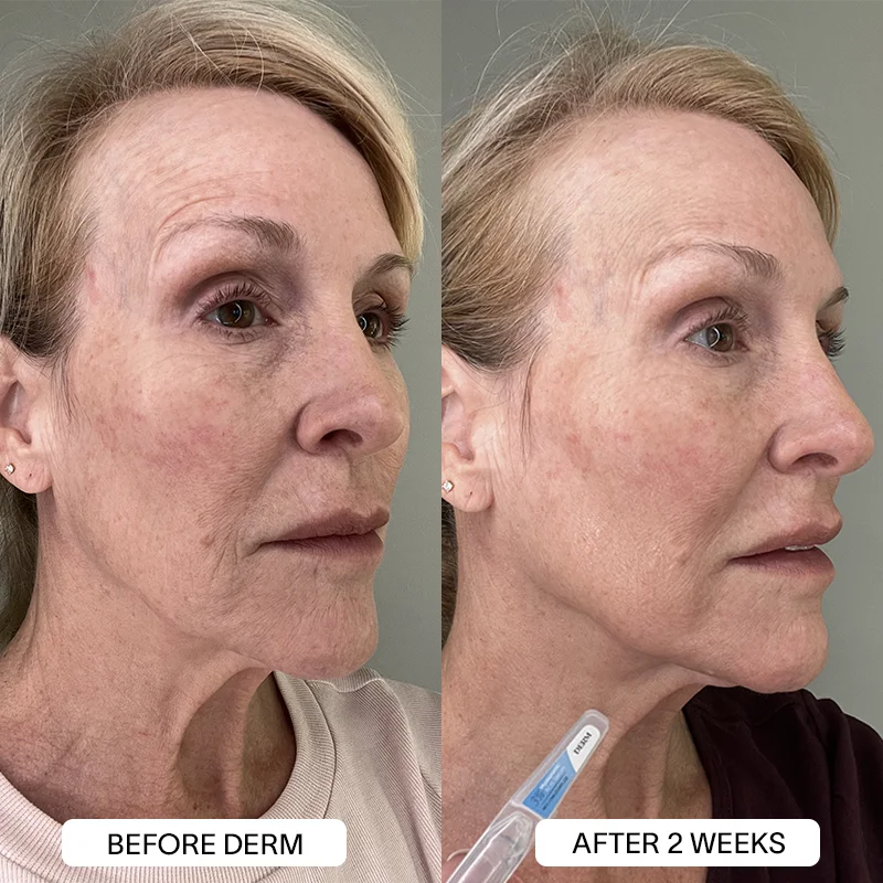 Derm™ 3% Hyaluronic Acid - Cyber Monday Sale - Image 16