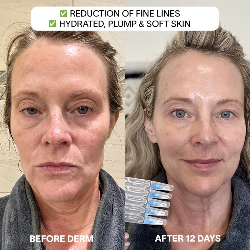 Derm™ 3% Hyaluronic Acid - Cyber Monday Sale - Image 4