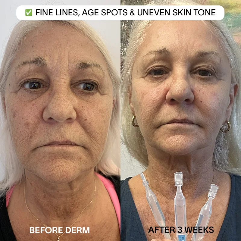 Derm™ 3% Hyaluronic Acid - Cyber Monday Sale - Image 5