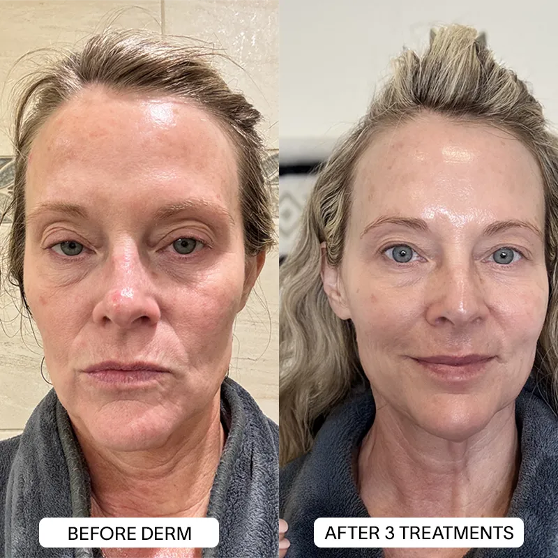 Derm™ PDRN Micro Infusion System - Image 14