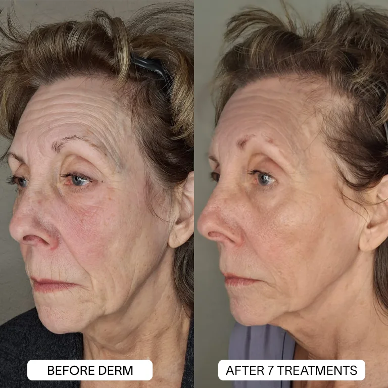 Derm™ PDRN Micro Infusion System - Image 3