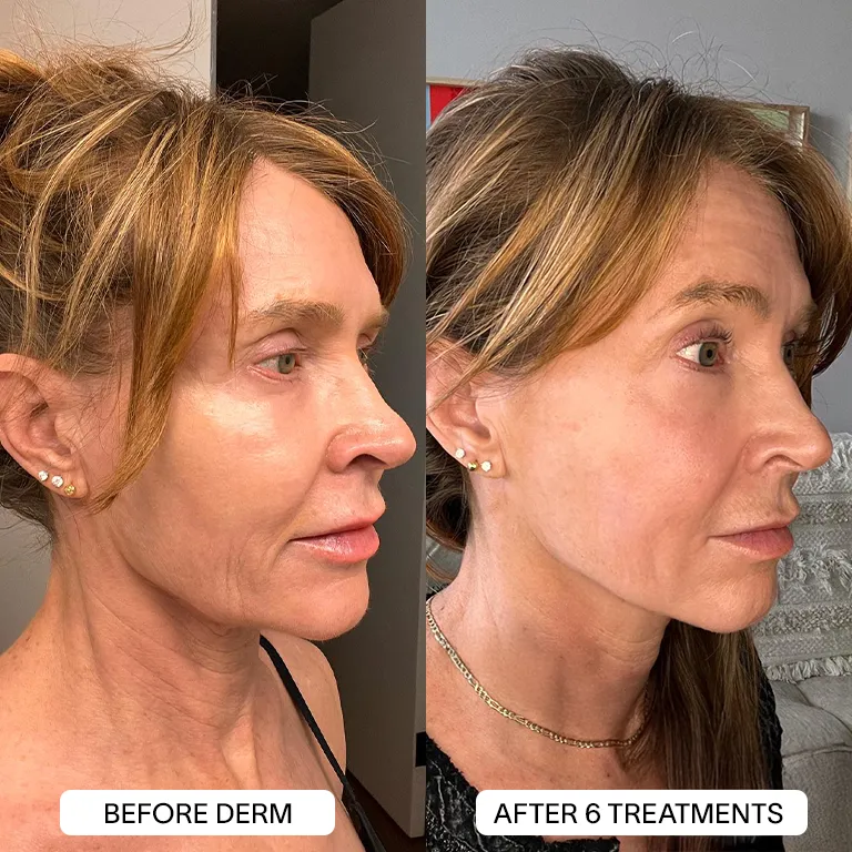 Derm™ PDRN Micro Infusion System - Image 5