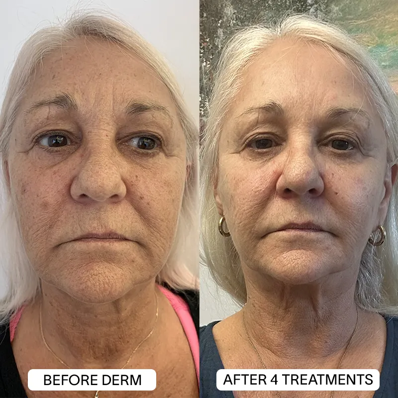 1x PDRN Micro Infusion Kit (2 treatments) - Image 10