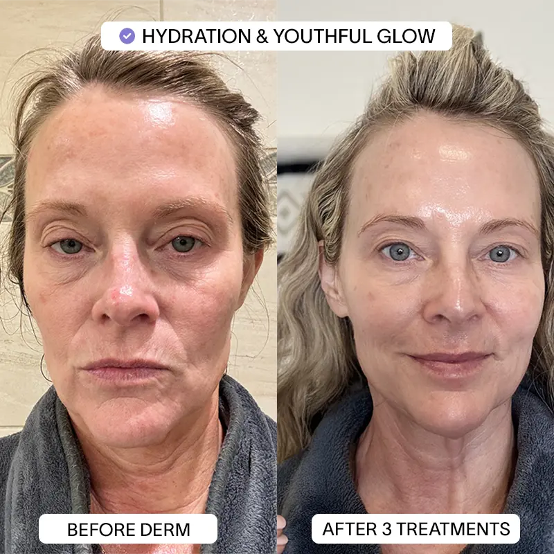 1x PDRN Micro Infusion Kit (2 treatments) - Image 11