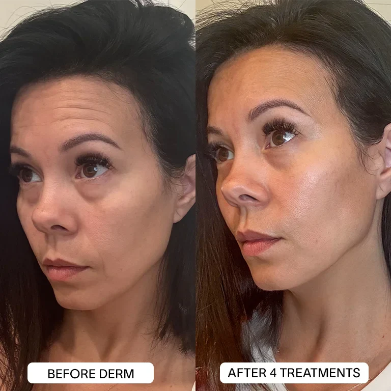 1x PDRN Micro Infusion Kit (2 treatments) - Image 12