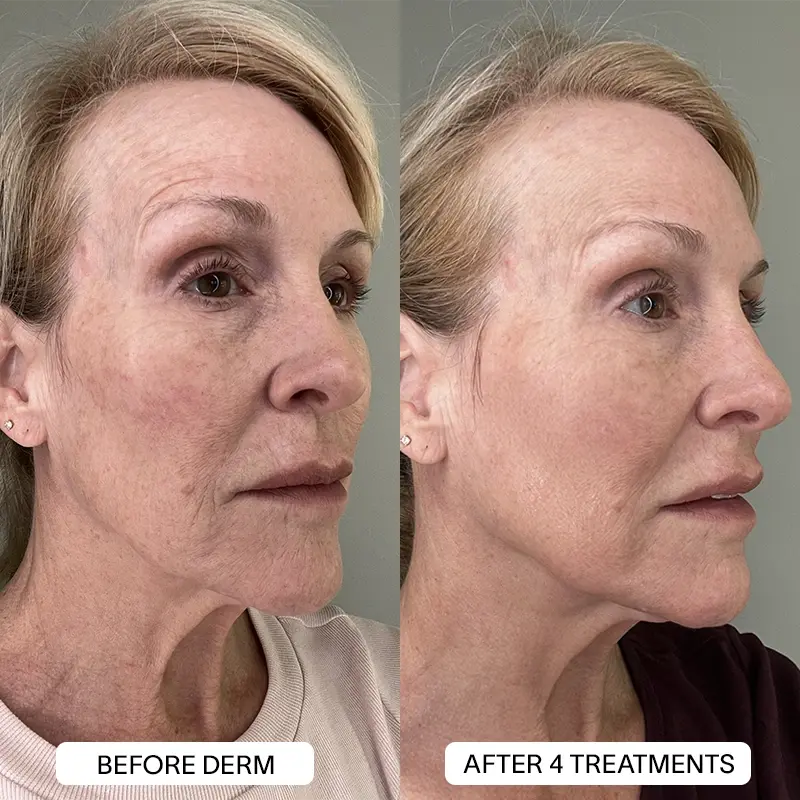 1x PDRN Micro Infusion Kit (2 treatments) - Image 13