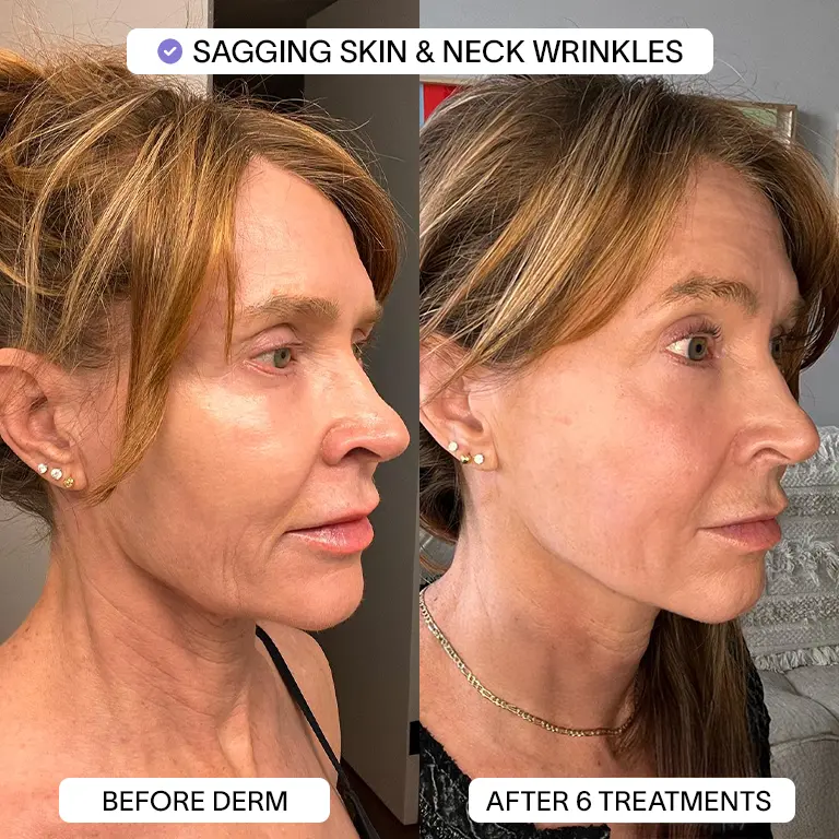 1x PDRN Micro Infusion Kit (2 treatments) - Image 3