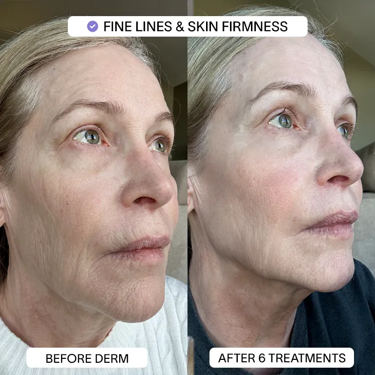 1x PDRN Micro Infusion Kit (2 treatments) - Image 4