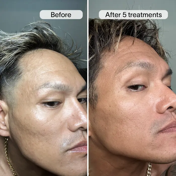 Derm™ PDRN Micro Infusion System - Image 8